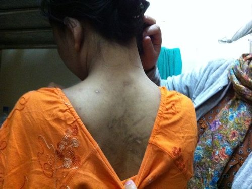A former domestic worker from Indonesia shows scars on her back
