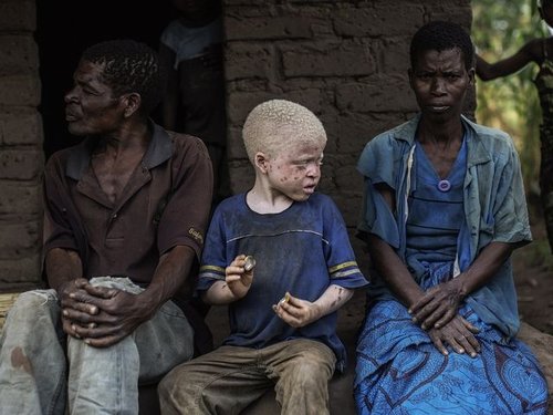 227457_malawi-albinos-feature.jpg