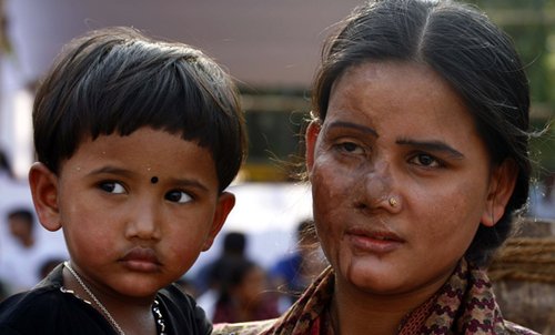 548x331_acid_attack_woman_with_child_in_bangladesh.jpg