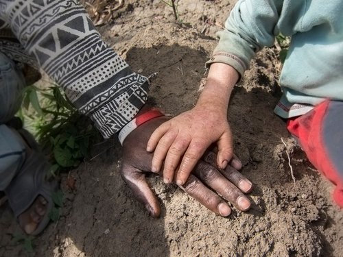 Malawi_albinism_0.jpg
