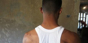 A victim of torture shows his scars